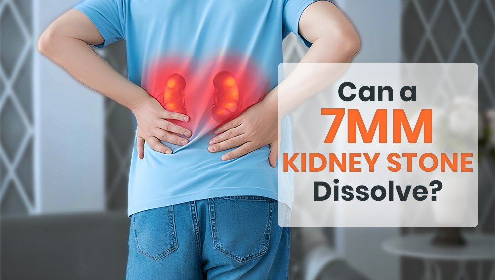 Can a 7mm Kidney Stone Dissolve?