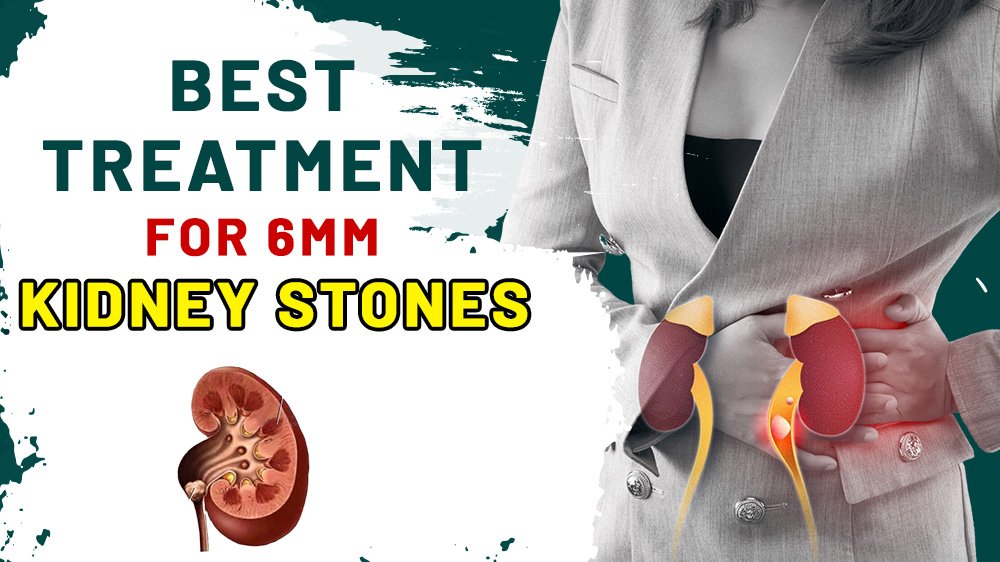 Best Treatment for 6mm Kidney Stones
