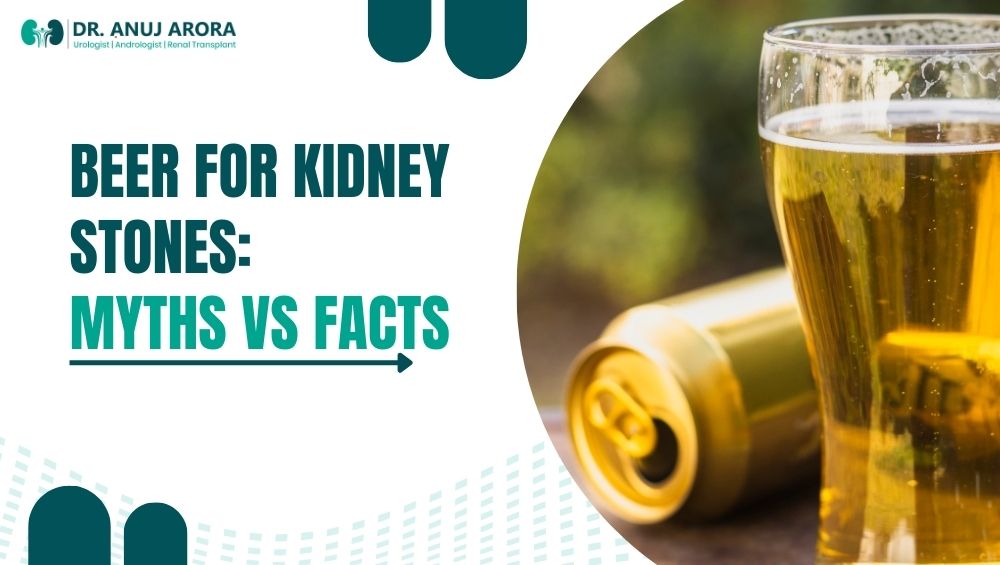 Beer for Kidney Stones
