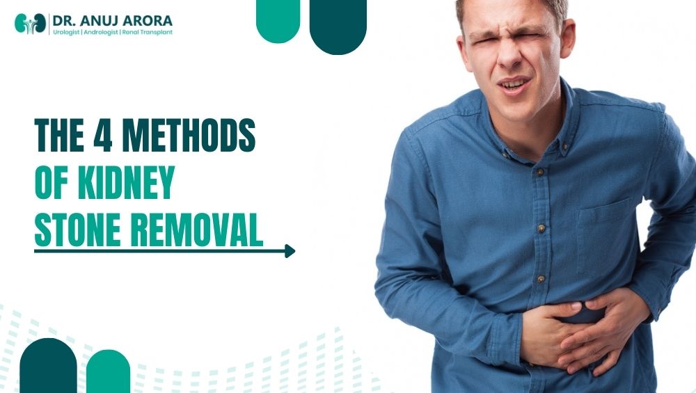 4 Methods of Kidney Stone Removal