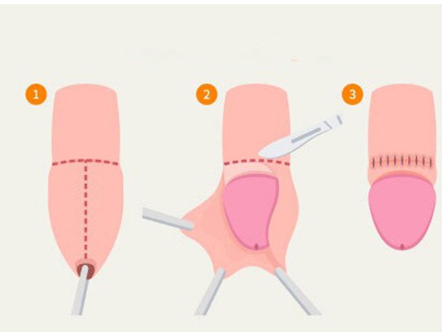 Circumcision Surgery in Noida
