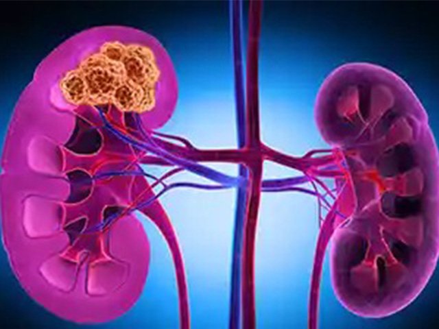 Urological Cancer Treatment In Noida