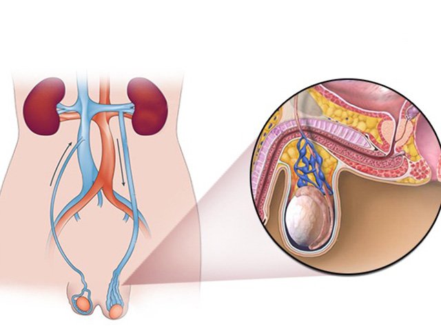Varicocele Treatment In Noida