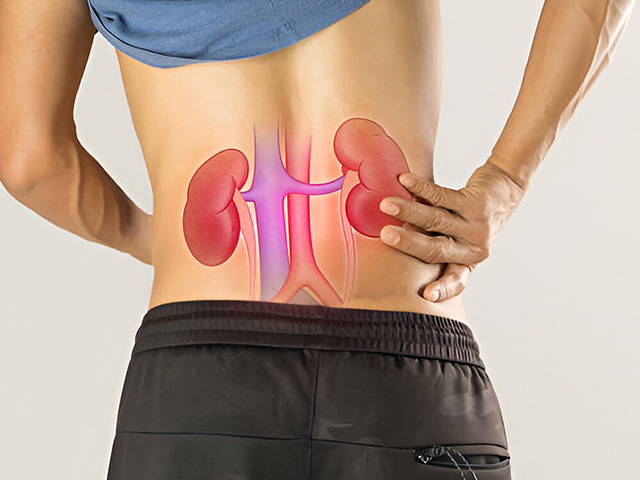 Symptoms of Kidney Stones