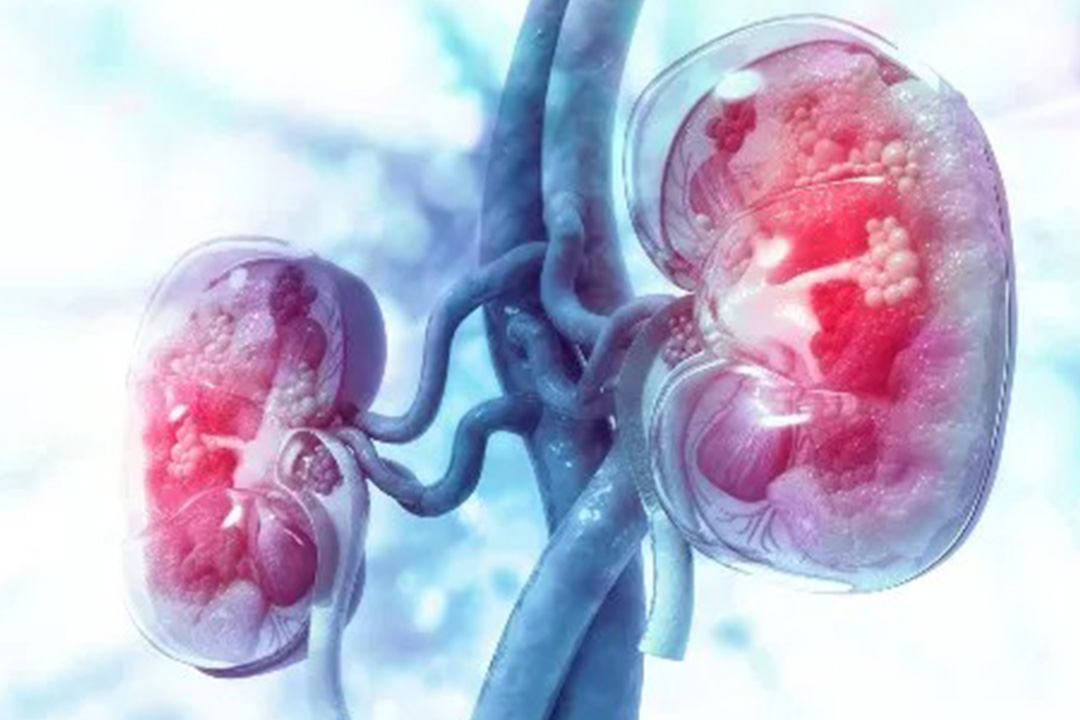 Procedure For Kidney Stones