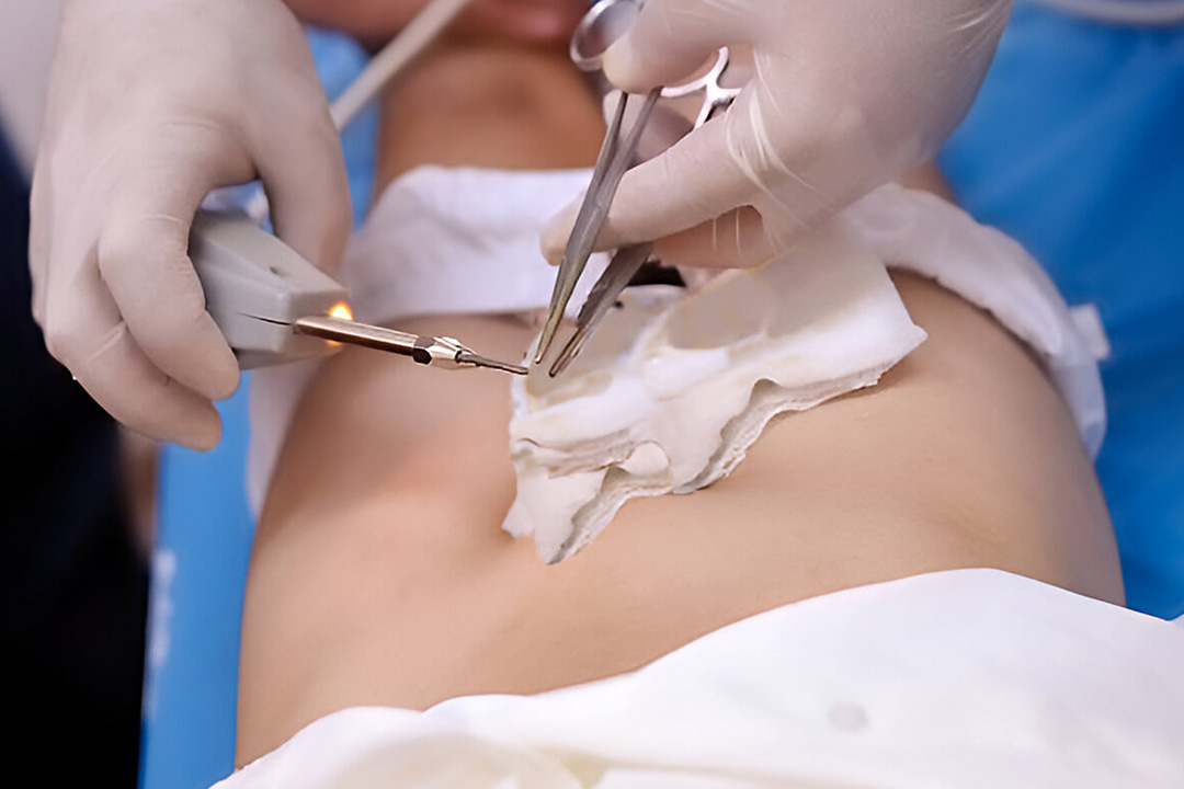 Procedure for Circumcision Surgery