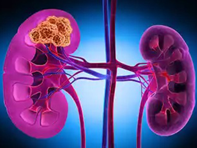 Best Urologist For Cancer Treatment in Noida