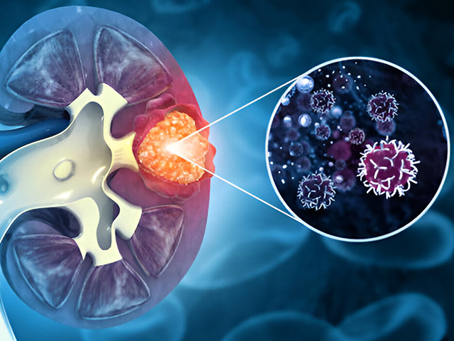 The Symptoms of Urological Cancers
