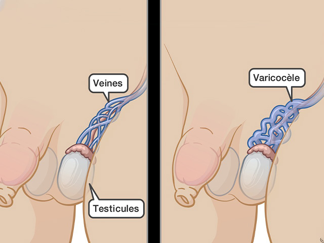 Varicocele Symptoms 