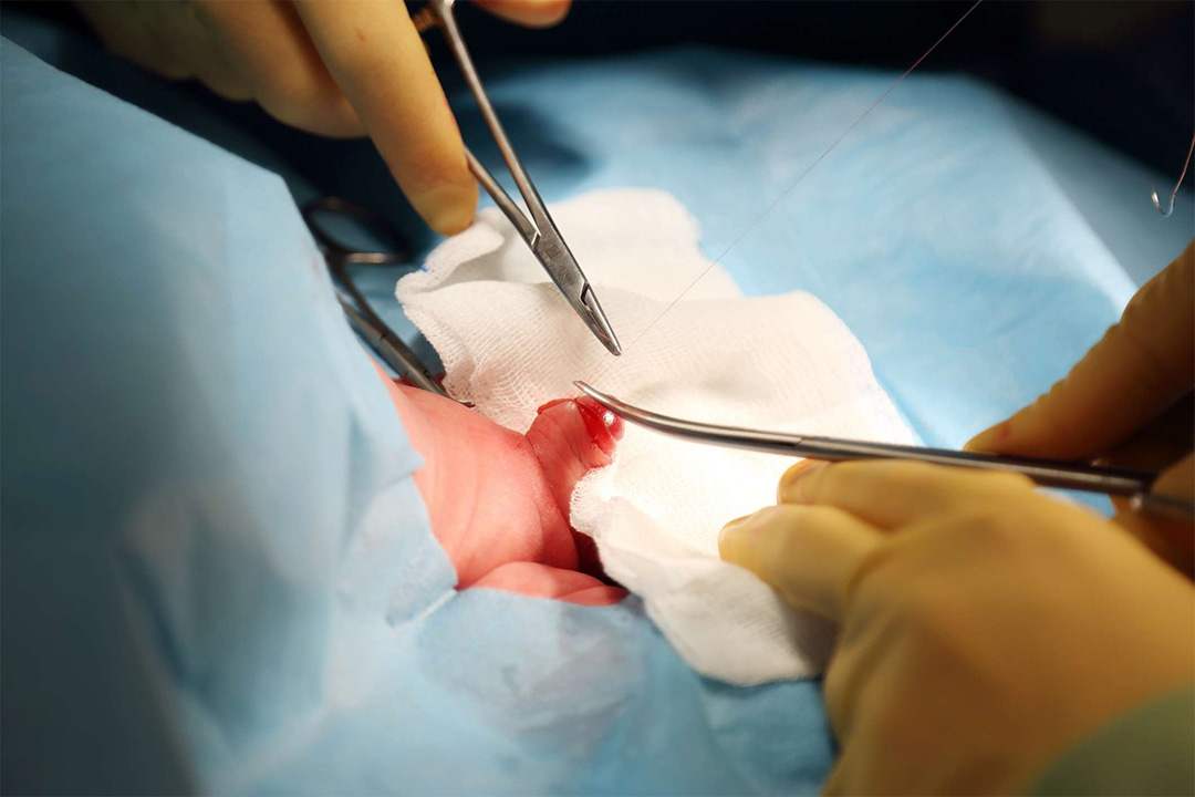 Why to Choose Us for Circumcision in Noida?